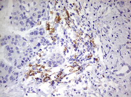 CD68 Antibody - IHC of paraffin-embedded Carcinoma of Human liver tissue using anti-CD68 mouse monoclonal antibody. (Heat-induced epitope retrieval by 10mM citric buffer, pH6.0, 120°C for 3min).