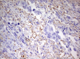 CD68 Antibody - IHC of paraffin-embedded Adenocarcinoma of Human ovary tissue using anti-CD68 mouse monoclonal antibody. (Heat-induced epitope retrieval by 10mM citric buffer, pH6.0, 120°C for 3min).