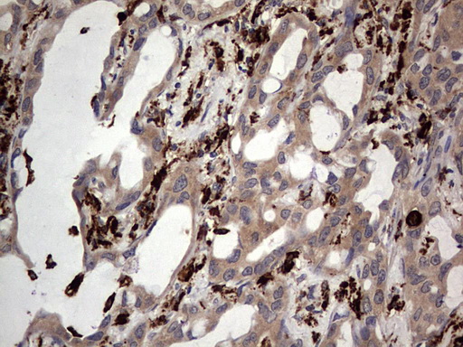 CD68 Antibody - IHC of paraffin-embedded Carcinoma of Human lung tissue using anti-CD68 mouse monoclonal antibody. (heat-induced epitope retrieval by 1 mM EDTA in 10mM Tris, pH8.5, 120°C for 3min).
