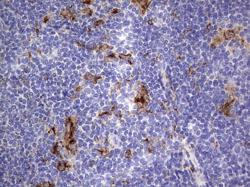 CD68 Antibody - IHC of paraffin-embedded Human lymphoma tissue using anti-CD68 mouse monoclonal antibody. (heat-induced epitope retrieval by 1 mM EDTA in 10mM Tris, pH8.5, 120°C for 3min).