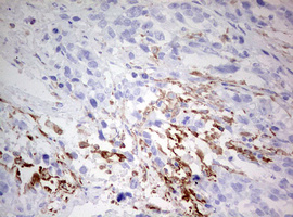CD68 Antibody - IHC of paraffin-embedded Adenocarcinoma of Human ovary tissue using anti-CD68 mouse monoclonal antibody. (Heat-induced epitope retrieval by 10mM citric buffer, pH6.0, 120°C for 3min).