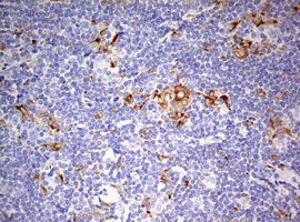 CD68 Antibody - IHC of paraffin-embedded Human lymphoma tissue using anti-CD68 mouse monoclonal antibody. (Heat-induced epitope retrieval by 10mM citric buffer, pH6.0, 120°C for 3min).