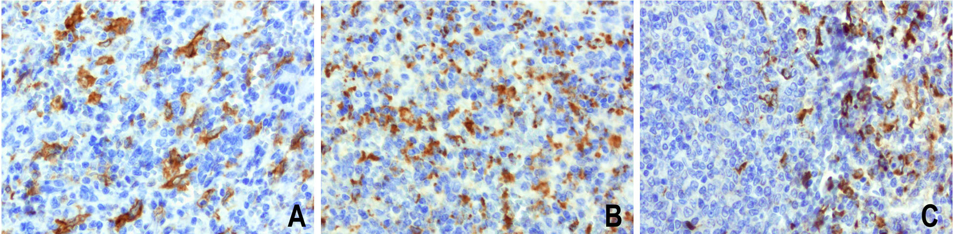 CD68 Antibody - Immunohistochemical staining of paraffin-embedded of 3 human spleen using anti-CD68 clone UMAB150 mouse monoclonal antibody at 1:200 dilution of 0.9mg/mL and detection with Polink2 Broad HRP DAB.requires heat-induced epitope retrieval with Accel 3in1 EDTA solution pH8.7 at 95-100C 20 minutes. The composit image of 3 human spleens show all showstrong membranous and cytoplasmic staining mainly in the red pulp region of spleen.