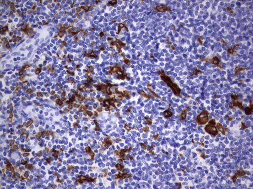 CD68 Antibody - Immunohistochemical staining of paraffin-embedded Human lymphoma tissue using anti-CD68 mouse monoclonal antibody.  heat-induced epitope retrieval by 10mM citric buffer, pH6.0, 120C for 3min)