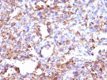 CD68 Antibody - Formalin-fixed, paraffin-embedded human Histiocytoma stained with CD68 antibody (CD68/G2).  This image was taken for the unmodified form of this product. Other forms have not been tested.