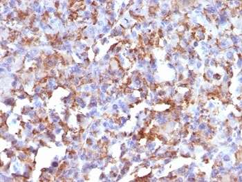 CD68 Antibody - Formalin-fixed, paraffin-embedded human histiocytoma stained with CD68 antibody (LAMP4/824).  This image was taken for the unmodified form of this product. Other forms have not been tested.