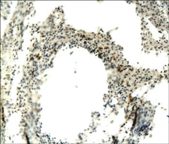 CD68 Antibody - Paraffin-embedded mouse cancerous lung is stained with CD68 Antibody used at a 1:50 dilution.