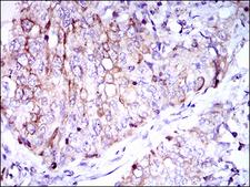 CD7 Antibody - IHC of paraffin-embedded lung cancer tissues using CD7 mouse monoclonal antibody with DAB staining.