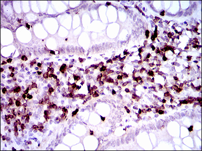 CD7 Antibody - IHC of paraffin-embedded endometrial cancer tissues using CD7 mouse monoclonal antibody with DAB staining.