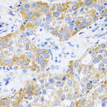 CD71 / Transferrin Receptor Antibody - Immunohistochemistry of paraffin-embedded human lung cancer tissue.