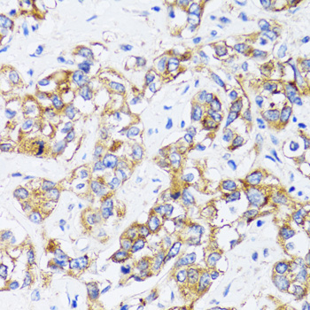 CD71 / Transferrin Receptor Antibody - Immunohistochemistry of paraffin-embedded human liver cancer tissue.