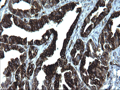 CD74 / CLIP Antibody - IHC of paraffin-embedded Adenocarcinoma of Human ovary tissue using anti-CD74 mouse monoclonal antibody. (Heat-induced epitope retrieval by 1 mM EDTA in 10mM Tris, pH8.5, 120°C for 3min).