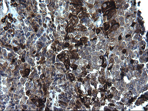 CD74 / CLIP Antibody - IHC of paraffin-embedded Adenocarcinoma of Human endometrium tissue using anti-CD74 mouse monoclonal antibody. (Heat-induced epitope retrieval by 1 mM EDTA in 10mM Tris, pH8.5, 120°C for 3min).