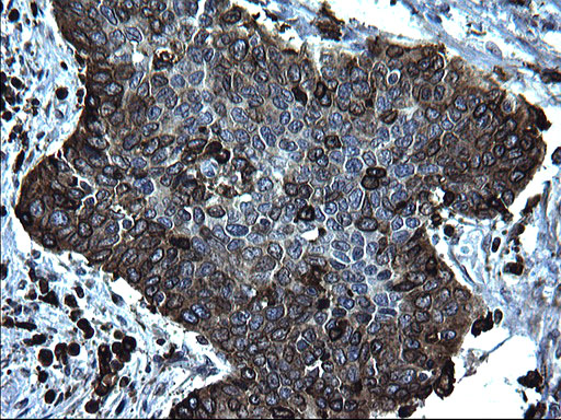 CD74 / CLIP Antibody - IHC of paraffin-embedded Carcinoma of Human bladder tissue using anti-CD74 mouse monoclonal antibody. (Heat-induced epitope retrieval by 1 mM EDTA in 10mM Tris, pH8.5, 120°C for 3min).