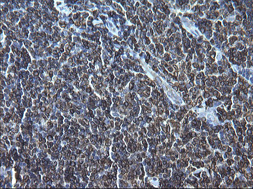 CD74 / CLIP Antibody - IHC of paraffin-embedded Human lymphoma tissue using anti-CD74 mouse monoclonal antibody. (Heat-induced epitope retrieval by 1 mM EDTA in 10mM Tris, pH8.5, 120°C for 3min).