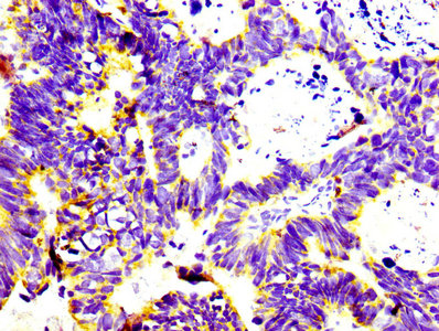 CD74 / CLIP Antibody - Immunohistochemistry Dilution at 1:100 and staining in paraffin-embedded human ovarian cancer performed on a Leica BondTM system. After dewaxing and hydration, antigen retrieval was mediated by high pressure in a citrate buffer (pH 6.0). Section was blocked with 10% normal Goat serum 30min at RT. Then primary antibody (1% BSA) was incubated at 4°C overnight. The primary is detected by a biotinylated Secondary antibody and visualized using an HRP conjugated SP system.