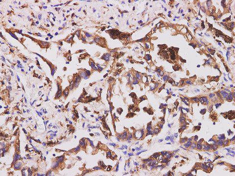 CD74 / CLIP Antibody - Immunohistochemistry of paraffin-embedded Human lung cancer using CD74 Polyclonal Antibody at dilution of 1:200.