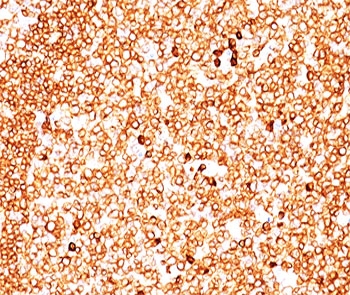 CD79A / CD79 Alpha Antibody - CD79a antibody JCB117 + HM47/A9 immunohistochemistry 1.  This image was taken for the unmodified form of this product. Other forms have not been tested.