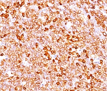 CD79A / CD79 Alpha Antibody - CD79a antibody JCB117 + HM47/A9 immunohistochemistry 2.  This image was taken for the unmodified form of this product. Other forms have not been tested.