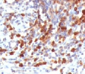 CD79A / CD79 Alpha Antibody - IHC testing of human lymphoma and CD79a antibody (CDLA79a-1).  This image was taken for the unmodified form of this product. Other forms have not been tested.