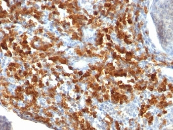 CD79A / CD79 Alpha Antibody - Formalin-fixed, paraffin-embedded human lymphoma stained with CD79a antibody (IGA/515).  This image was taken for the unmodified form of this product. Other forms have not been tested.