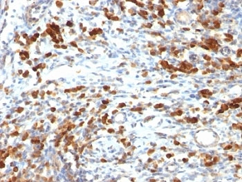 CD79A / CD79 Alpha Antibody - Formalin-fixed, paraffin-embedded human lymphoma stained with CD79a antibody (IGA/764).  This image was taken for the unmodified form of this product. Other forms have not been tested.