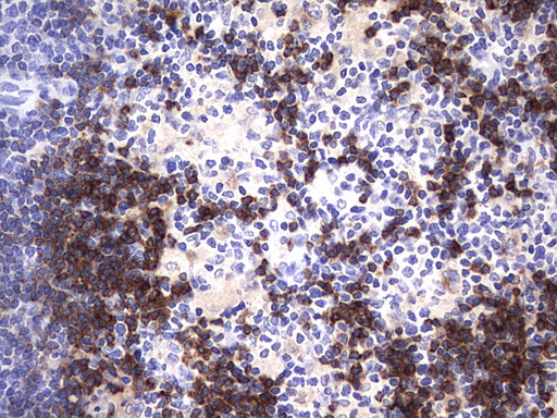CD79A / CD79 Alpha Antibody - IHC of paraffin-embedded Human lymphoma tissue using anti-CD79A mouse monoclonal antibody. (Heat-induced epitope retrieval by 1 mM EDTA in 10mM Tris, pH8.5, 120°C for 3min).