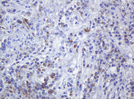 CD79A / CD79 Alpha Antibody - IHC of paraffin-embedded Carcinoma of Human lung tissue using anti-CD79A mouse monoclonal antibody.