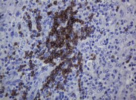 CD79A / CD79 Alpha Antibody - IHC of paraffin-embedded Human lymphoma tissue using anti-CD79A mouse monoclonal antibody.