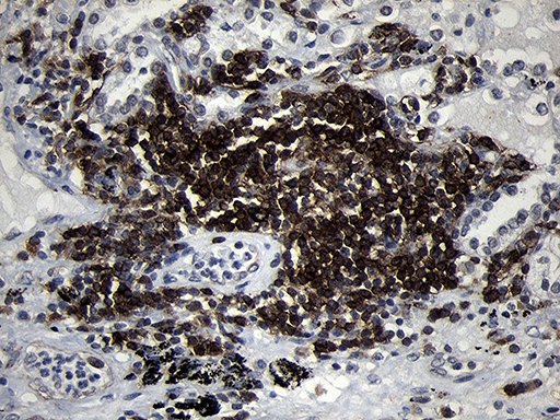 CD79B / CD79 Beta Antibody - Immunohistochemical staining of paraffin-embedded Carcinoma of Human lung tissue using anti-CD79B mouse monoclonal antibody. (Heat-induced epitope retrieval by 1mM EDTA in 10mM Tris buffer. (pH8.5) at 120°C for 3 min. (1:2000)