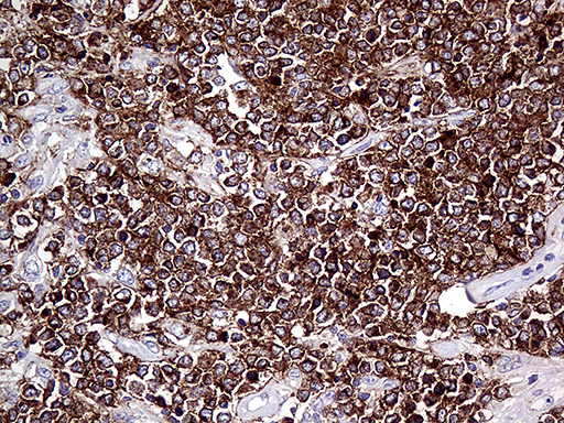 CD79B / CD79 Beta Antibody - Immunohistochemical staining of paraffin-embedded Human lymphoma tissue using anti-CD79B mouse monoclonal antibody. (Heat-induced epitope retrieval by 1mM EDTA in 10mM Tris buffer. (pH8.5) at 120°C for 3 min. (1:2000)
