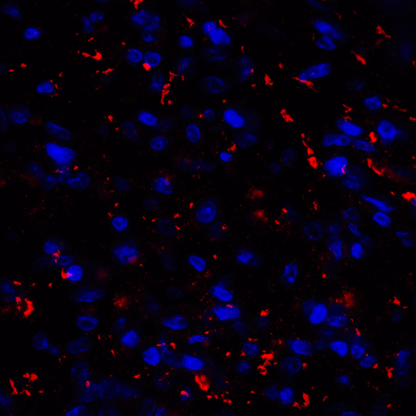 CD80 Antibody - Immunofluorescence of CD80 in human stomach carcinoma tissue with CD80 antibody at 20 ug/mL. Red: CD80 Antibody [10A1] Blue: DAPI staining