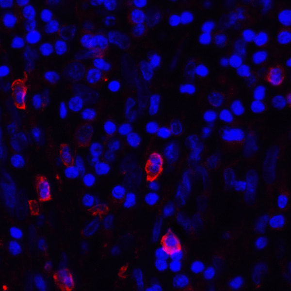 CD80 Antibody - Immunofluorescence of CD80 in human stomach carcinoma tissue with CD80 antibody at 20 ug/mL. Red: CD80 Antibody [11C12] Blue: DAPI staining