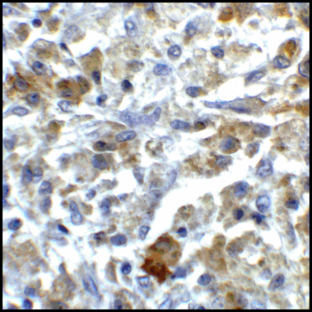 CD80 Antibody - Immunohistochemistry of CD80 in human stomach carcinoma tissue with CD80 antibody at 5 ug/mL.