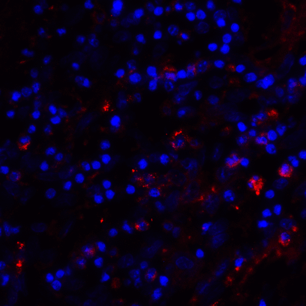 CD80 Antibody - Immunofluorescence of CD80 in human stomach carcinoma tissue with CD80 antibody at 20 ug/mL. Red: CD80 Antibody [11D1] Blue: DAPI staining