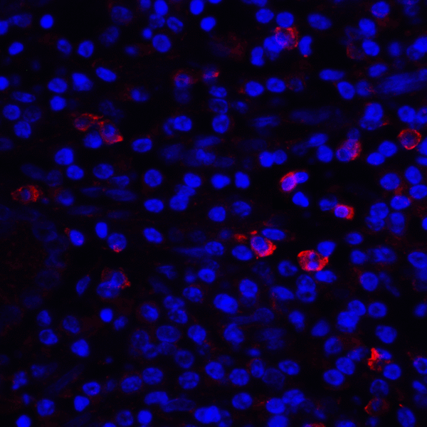 CD80 Antibody - Immunofluorescence of CD80 in human stomach carcinoma tissue with CD80 antibody at 20 ug/mL. Red: CD80 Antibody [12D9] Blue: DAPI staining