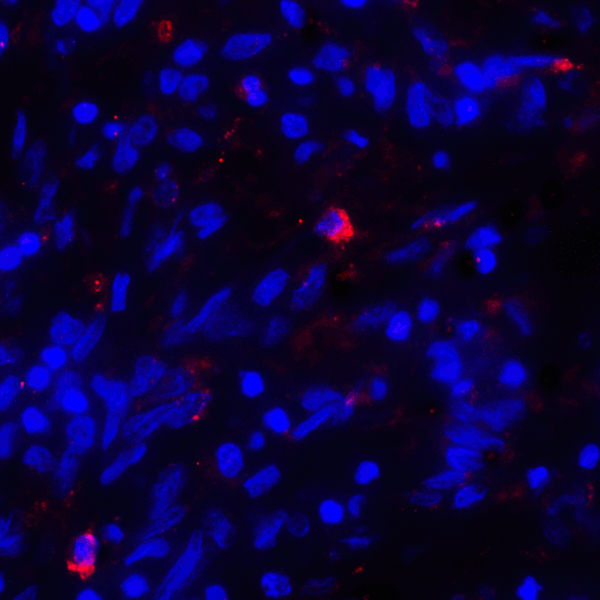 CD80 Antibody - Immunofluorescence of CD80 in human stomach carcinoma tissue with CD80 antibody at 20 ug/mL. Red: CD80 Antibody [7A2] Blue: DAPI staining