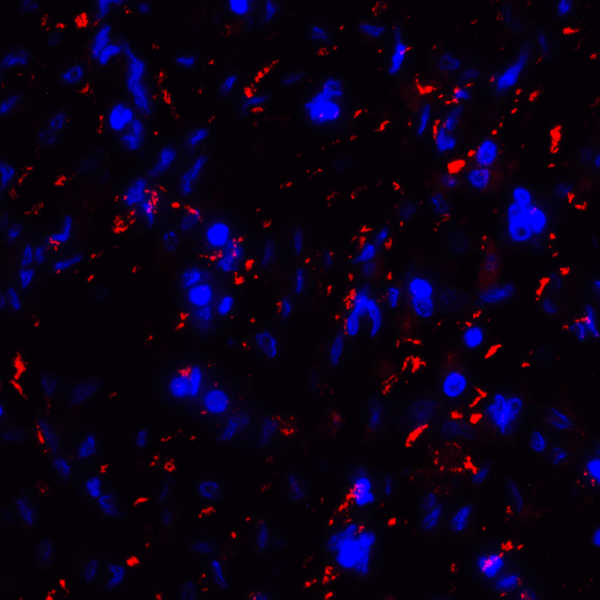 CD80 Antibody - Immunofluorescence of CD80 in human stomach carcinoma tissue with CD80 antibody at 20 ug/mL. Red: CD80 Antibody [8G12] Blue: DAPI staining