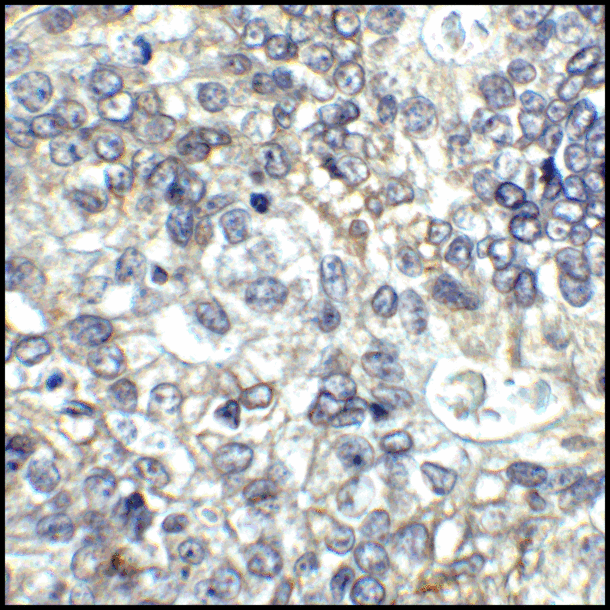 CD80 Antibody - Immunohistochemistry of CD80 in human stomach carcinoma tissue with CD80 antibody at 5 ug/mL.