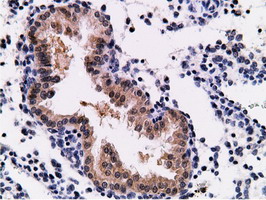 CD80 Antibody - Immunohistochemical staining of paraffin-embedded Carcinoma of Human prostate tissue using anti-CD80 mouse monoclonal antibody.