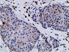 CD80 Antibody - Immunohistochemical staining of paraffin-embedded Adenocarcinoma of Human breast tissue using anti-CD80 mouse monoclonal antibody.