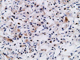CD80 Antibody - Immunohistochemical staining of paraffin-embedded Carcinoma of Human kidney tissue using anti-CD80 mouse monoclonal antibody.