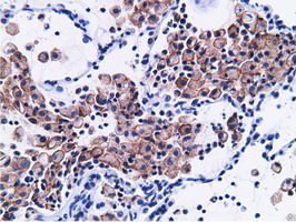 CD80 Antibody - Immunohistochemical staining of paraffin-embedded Carcinoma of Human lung tissue using anti-CD80 mouse monoclonal antibody.