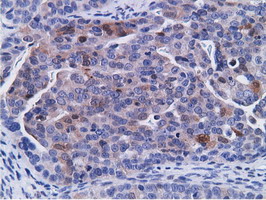 CD80 Antibody - Immunohistochemical staining of paraffin-embedded Adenocarcinoma of Human ovary tissue using anti-CD80 mouse monoclonal antibody.