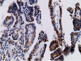 CD80 Antibody - Immunohistochemical staining of paraffin-embedded Carcinoma of Human thyroid tissue using anti-CD80 mouse monoclonal antibody.