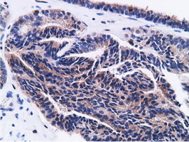 CD80 Antibody - Immunohistochemical staining of paraffin-embedded Adenocarcinoma of Human endometrium tissue using anti-CD80 mouse monoclonal antibody.