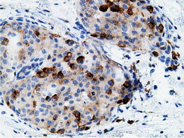 CD80 Antibody - IHC of paraffin-embedded Adenocarcinoma of Human breast tissue using anti-CD80 mouse monoclonal antibody.