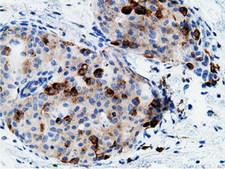 CD80 Antibody - IHC of paraffin-embedded Adenocarcinoma of Human breast tissue using anti-CD80 mouse monoclonal antibody.
