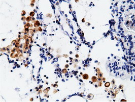 CD80 Antibody - IHC of paraffin-embedded Carcinoma of Human lung tissue using anti-CD80 mouse monoclonal antibody.