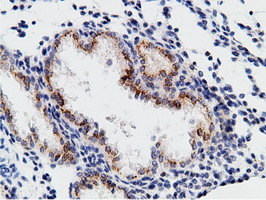 CD80 Antibody - IHC of paraffin-embedded Carcinoma of Human prostate tissue using anti-CD80 mouse monoclonal antibody.